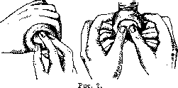 Paraphimosis: figure 1 from the 1928–1936 encyclopedia article