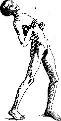 Parinaud Syndrome: figure 3 from the 1928–1936 encyclopedia article