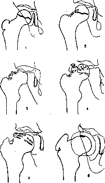 Perthes' Disease: figure 1 from the 1928–1936 encyclopedia article