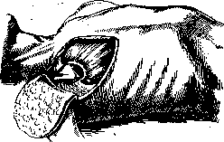 Pleurisy: figure 14 from the 1928–1936 encyclopedia article