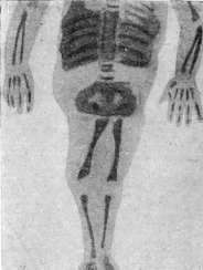 Pleurisy: figure 3 from the 1928–1936 encyclopedia article