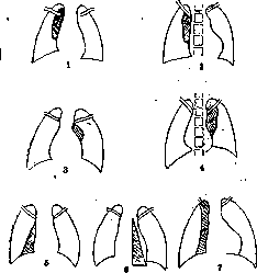 Pleurisy: figure 6 from the 1928–1936 encyclopedia article