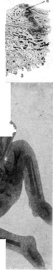 Pleurisy: figure 2 from the 1928–1936 encyclopedia article