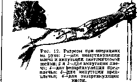 Arm (Humerus): figure 11 from the 1928–1936 encyclopedia article