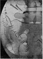 Fetus: figure 8 from the 1928–1936 encyclopedia article