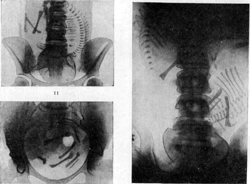 Fetus: figure 12 from the 1928–1936 encyclopedia article