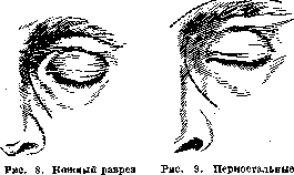 Paranasal Sinuses (air-containing sinuses, adjacent to the proper): figure 7 from the 1928–1936 encyclopedia article