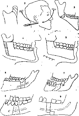 Progenia, Prognathia: figure 3 from the 1928–1936 encyclopedia article