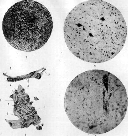 Progressive Paralysis: figure 2 from the 1928–1936 encyclopedia article