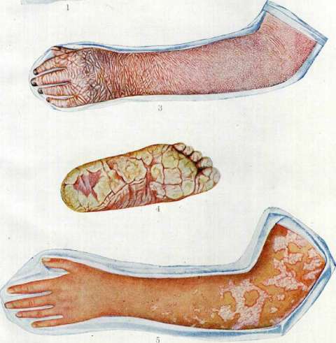 Psoriasis: figure 2 from the 1928–1936 encyclopedia article