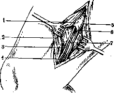 Neurotomy: figure 3 from the 1928–1936 encyclopedia article