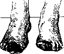 Neurotomy: figure 6 from the 1928–1936 encyclopedia article