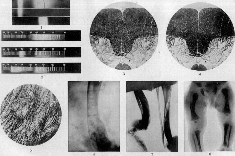 Neurofibroma: figure 1 from the 1928–1936 encyclopedia article