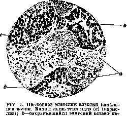 Necrosis: figure 2 from the 1928–1936 encyclopedia article