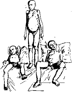 Edematous Disease: figure 1 from the 1928–1936 encyclopedia article