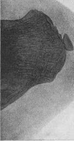 Apostoli Condenser Bed: figure 1 from the 1928–1936 encyclopedia article