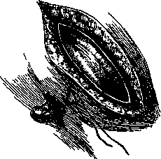 Appendicostomy: figure 1 from the 1928–1936 encyclopedia article