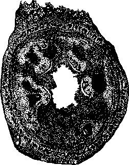 Appendicitis: figure 2 from the 1928–1936 encyclopedia article