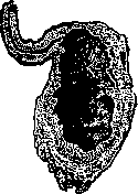 Appendicitis: figure 3 from the 1928–1936 encyclopedia article