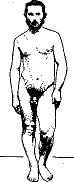 Muscle Atrophy in Diseases of the Nervous System: figure 2 from the 1928–1936 encyclopedia article