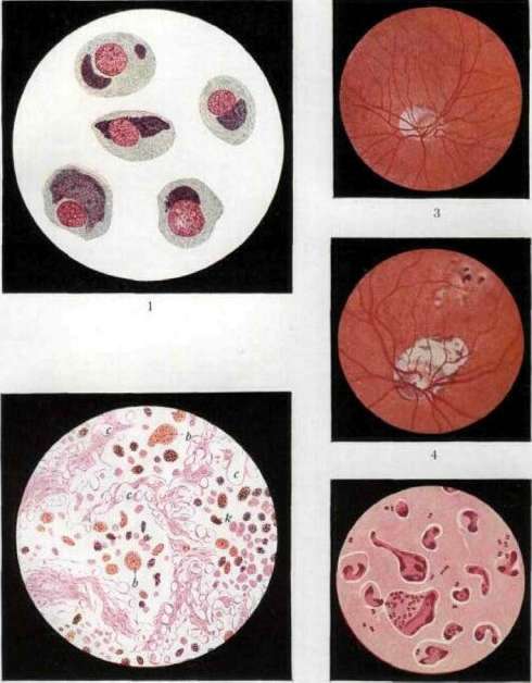 Blennorrhea: figure 1 from the 1928–1936 encyclopedia article