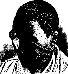 Blepharoplasty: figure 2 from the 1928–1936 encyclopedia article