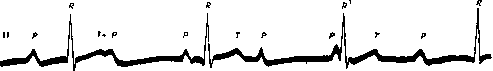 Heart Block: figure 5 from the 1928–1936 encyclopedia article