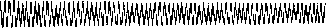 Heart Block: figure 3 from the 1928–1936 encyclopedia article