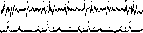 Heart Block: figure 6 from the 1928–1936 encyclopedia article