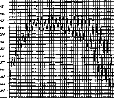 Typhoid Fever: figure 20 from the 1928–1936 encyclopedia article