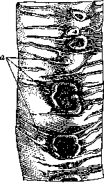 Typhoid Fever: figure 18 from the 1928–1936 encyclopedia article
