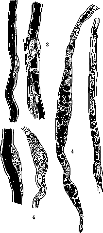 Wallenberg Syndrome and Waller's Degeneration: figure 1 from the 1928–1936 encyclopedia article