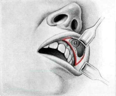 Maxillary Sinusitis: figure 2 from the 1928–1936 encyclopedia article