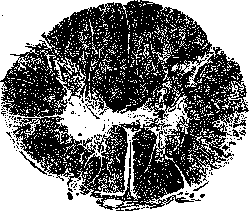 Heine-Medin Disease: figure 2 from the 1928–1936 encyclopedia article