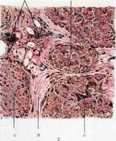 Hemochromatosis: figure 1 from the 1928–1936 encyclopedia article