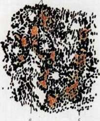Hemochromatosis: figure 2 from the 1928–1936 encyclopedia article