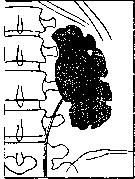 Hydronephrosis: figure 4 from the 1928–1936 encyclopedia article