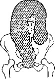 Hirschsprung Disease: figure 1 from the 1928–1936 encyclopedia article