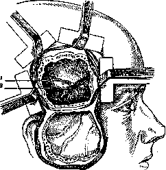 Brain (551 General diagnostics of brain diseases): figure 45 from the 1928–1936 encyclopedia article