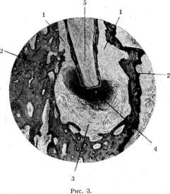Granulomas: figure 3 from the 1928–1936 encyclopedia article