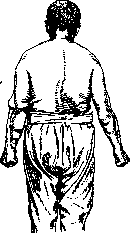 Dercum Disease: figure 2 from the 1928–1936 encyclopedia article