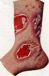 Dermatitis: figure 2 from the 1928–1936 encyclopedia article