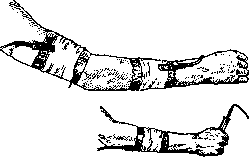 Diathermy: figure 5 from the 1928–1936 encyclopedia article