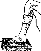 Diathermy: figure 4 from the 1928–1936 encyclopedia article