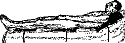 Diathermy: figure 6 from the 1928–1936 encyclopedia article