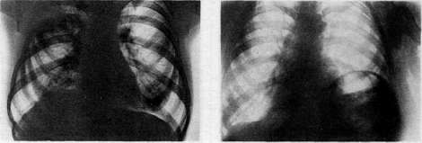 Diaphragm: figure 10 from the 1928–1936 encyclopedia article
