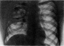 Diaphragm: figure 9 from the 1928–1936 encyclopedia article