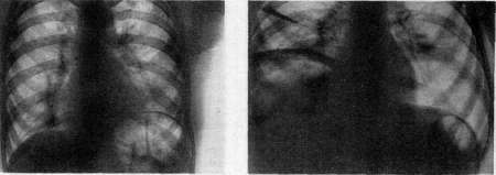 Diaphragm: figure 7 from the 1928–1936 encyclopedia article