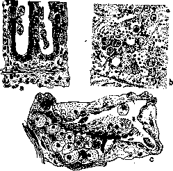 Dysentery: figure 4 from the 1928–1936 encyclopedia article