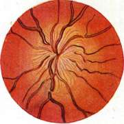 Papilledema: figure 1 from the 1928–1936 encyclopedia article